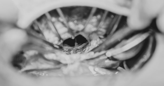 Prolapso de válvula mitral sin tratar puede provocar fibrilación atrial o rotura de cuerdas tendinosas