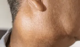 Ganglios linfáticos inflamados como señal de cáncer, infección viral o trastornos autoinmunes