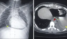 Perforación esofágica por ingestión de espina de pescado genera pericarditis y neumopericardio