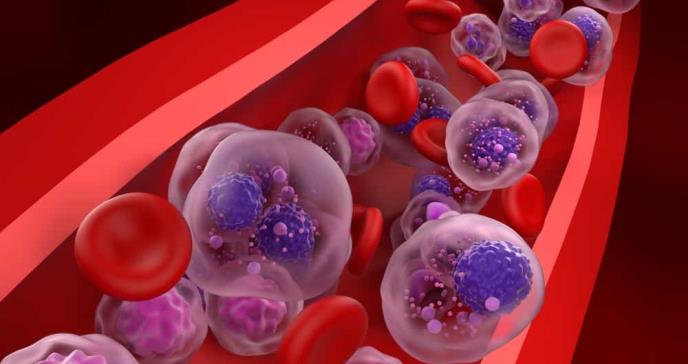 Investigación internacional desarrolla nuevo modelo para predecir respuesta del CAR-T en mieloma múltiple