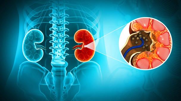 Metformina podría reducir significativamente el riesgo de complicaciones renales por diabetes tipo 2 Metformina podría reducir significativamente el riesgo de complicaciones renales por diabetes tipo 2