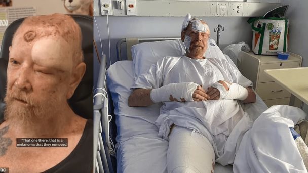 Hombre es diagnosticado con más de 200 cánceres de piel tras larga exposición al sol sin protección Hombre es diagnosticado con más de 200 cánceres de piel tras larga exposición al sol sin protección
