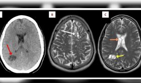 Hallan múltiples gusanos parasitarios en el cerebro de un hombre por comer tocino poco cocido