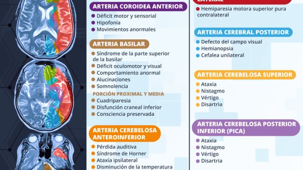 Cerebro: territorios vasculares | Infografía Cerebro: territorios vasculares | Infografía