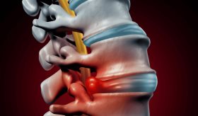 Diabetes tipo 2 altera anatomía estructural de discos en la columna vertebral y reduce su funcionalidad