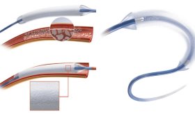 ¿Cómo es el balón famarcoactivo para limpiar arterias coronarias y por qué es más seguro que otros métodos?