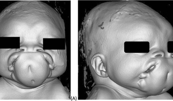 Describen rara duplicación facial o diprosopus en recién nacida: solo hay 36 casos reportados en el mundo