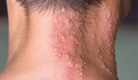 Diabetes y condiciones crónicas aumentan riesgo de complicaciones por herpes zóster como hospitalización