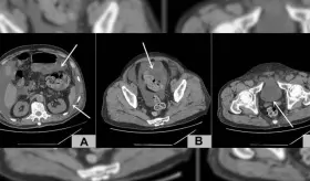Infección por herpes zóster provoca retención urinaria y ruptura espontánea de vejiga