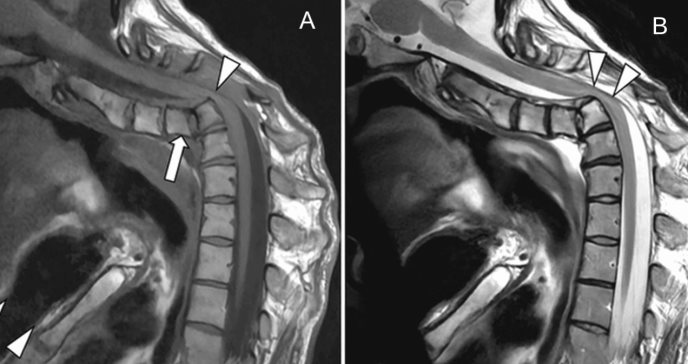 Lesión causada en fisioterapia desencadena luxación cervical completa traumática con cifosis fija