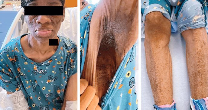 Paciente con diabetes tipo 2 presentó hiperglucemia pese a recibir más de 2000 unidades de insulina diarias