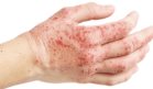 Pacientes con dermatitis atópica tendrían mayor riesgo de padecer colitis ulcerosa o enfermedad de Crohn