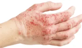 Pacientes con dermatitis atópica tendrían mayor riesgo de padecer colitis ulcerosa o enfermedad de Crohn