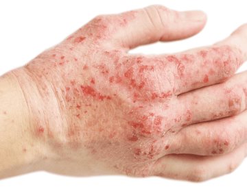 Pacientes con dermatitis atópica tendrían mayor riesgo de padecer colitis ulcerosa o enfermedad de Crohn