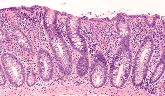 Colitis microscópica: la enfermedad intestinal difícil de detectar que más afecta a mujeres