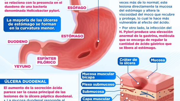 Úlceras pépticas | Infografía Úlceras pépticas | Infografía