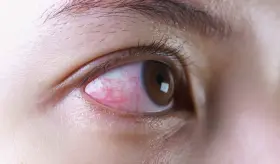 &iquest;Por qu&eacute; duelen los ojos luego del eclipse solar? Reconozca los signos de da&ntilde;o ocular o retinopat&iacute;a solar