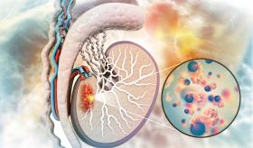 Seminomas y no seminomas en cáncer testicular: Signos y señales tempranas de malignidad en testículos