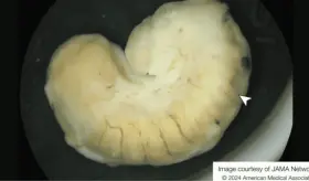 Hallan larva pálida en ojo de paciente que habría consumido carne de cocodrilo contaminada