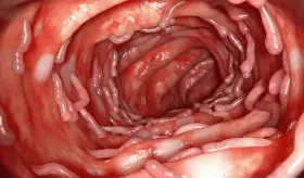 Alimentos ultraprocesados alargan los episodios de colitis ulcerosa y aumentan la inflamación intestinal