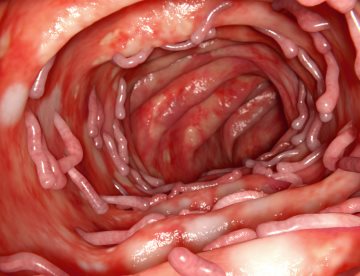 Alimentos ultraprocesados alargan los episodios de colitis ulcerosa y aumentan la inflamación intestinal