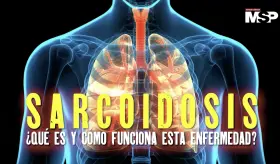Día Mundial de la Sarcoidosis: ¿Qué es y cómo funciona esta enfermedad? - #ExclusivoMSP