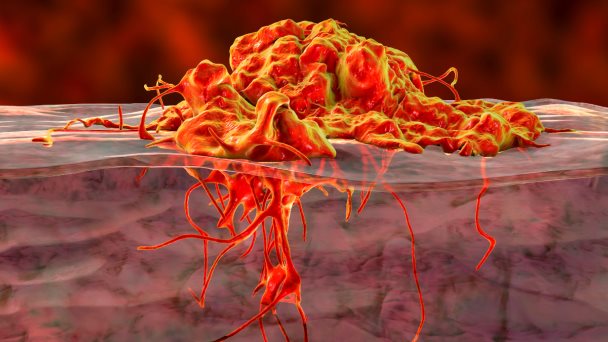 Cáncer de piel: ¿Cómo el melanoma rompe los genes y evade el tratamiento? Cáncer de piel: ¿Cómo el melanoma rompe los genes y evade el tratamiento?