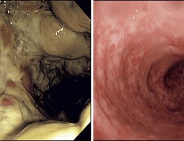 Enema de café ocasiona proctocolitis grave y necrosis de tejido intestinal