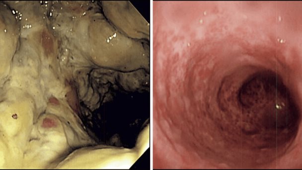 Enema de café ocasiona proctocolitis grave y necrosis de tejido intestinal Enema de café ocasiona proctocolitis grave y necrosis de tejido intestinal