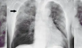 Nuevo fármaco podría prevenir inflamación descontrolada y daño pulmonar inducido por gripe