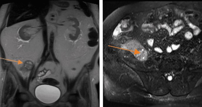 Paciente desarrolló carcinoma de células renales tras recibir trasplante de riñón