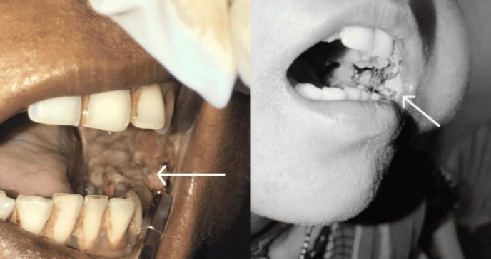 Raro caso de agresivo carcinoma de células escamosas en mucosa oral por tabaco de mascar