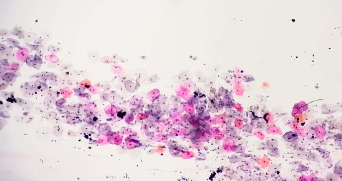Identifican genes que aumentan riesgo de infecciones persistentes por VPH y desarrollo de cáncer cervical