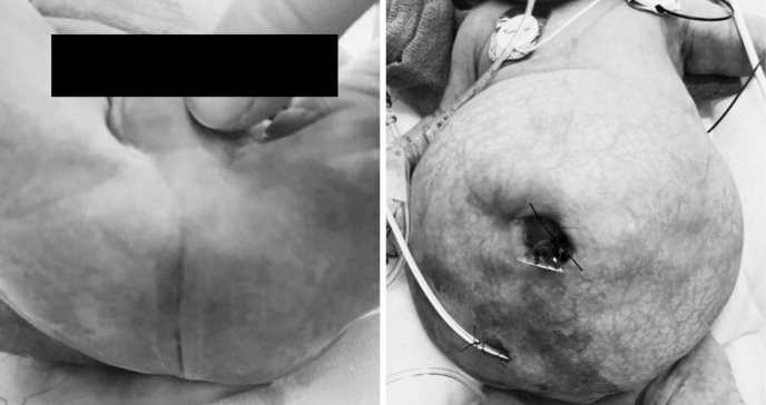 Recién nacida con malformación cloacal requirió reconstrucción del tracto vaginal y colostomía