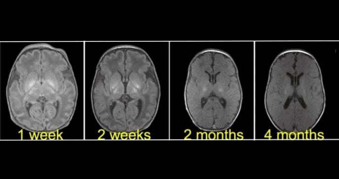 Complicación por anormalidad uterina: bebé sufre parálisis cerebral tras parto prematuro y asfixia grave