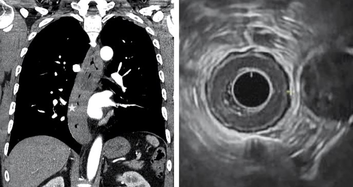 Detectan raro estrechamiento esofágico por esofagitis en paciente con disfagia