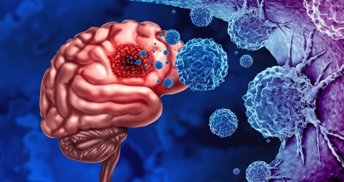 Reducción significativa del tamaño del tumor en pacientes con glioblastoma tratados con vacuna de ARNm