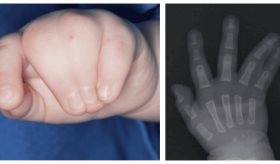 Parche genético es capaz de corregir síndrome asociado con el autismo 