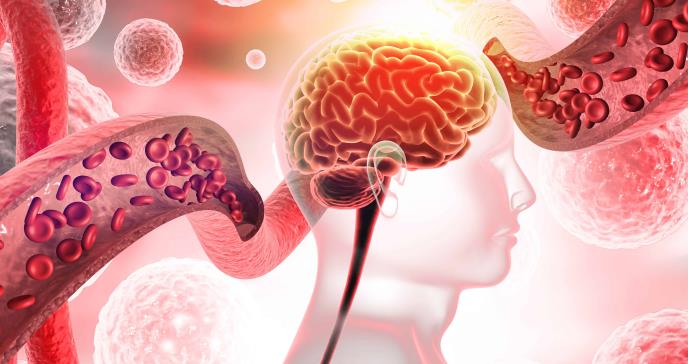 Análisis de sangre como biomarcador de riesgo de accidente cerebrovascular