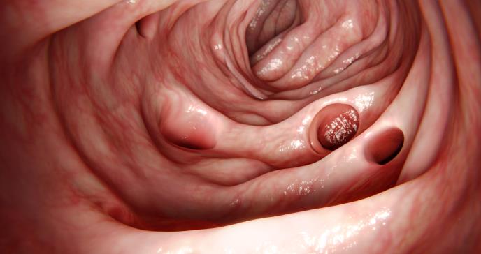 Tabaquismo y consumo de alcohol son factores de riesgo para el desarrollo de diverticulitis en mujeres