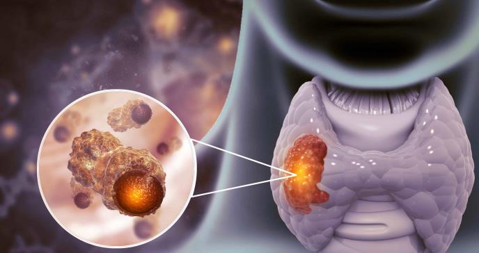El papel fundamental de la ecografía y la biopsia en los nódulos tiroideos