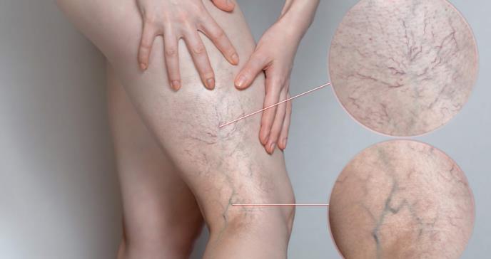 ¿Qué le pasa a mis venas? Trombosis venosa superficial y varices, explicadas de forma sencilla