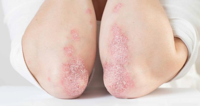 Por primera vez logran esclarecer prevalencia global de la artritis psoriásica: 112 casos por cada 100.000