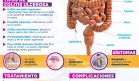 Colitis ulcerosa | Infografía