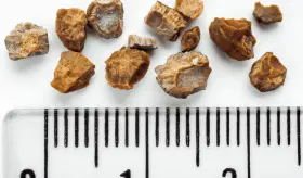 ¿Por qué se forman los cálculos renales, tonsilolitos y diferentes piedras en nuestro cuerpo?