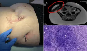 Fístulas conllevan a diagnóstico de Enfermedad de Crohn metastásica en paciente femenina