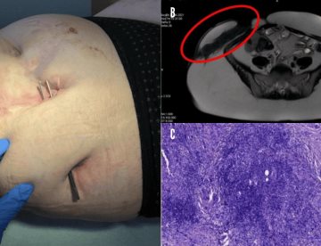 Fístulas conllevan a diagnóstico de Enfermedad de Crohn metastásica en paciente femenina