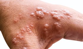 ¿Qué es la neuralgia posherpética y por qué es una dolorosa complicación del herpes zóster?