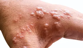 &iquest;Qu&eacute; es la neuralgia posherp&eacute;tica y por qu&eacute; es una dolorosa complicaci&oacute;n del herpes z&oacute;ster?