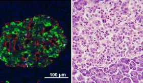 Reportan un primer paciente "curado" de diabetes tipo 2 gracias a un trasplante celular en China